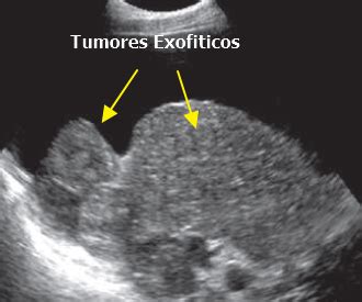 Ultrasonido Lesiones Focales Del H Gado Gastro M Rida