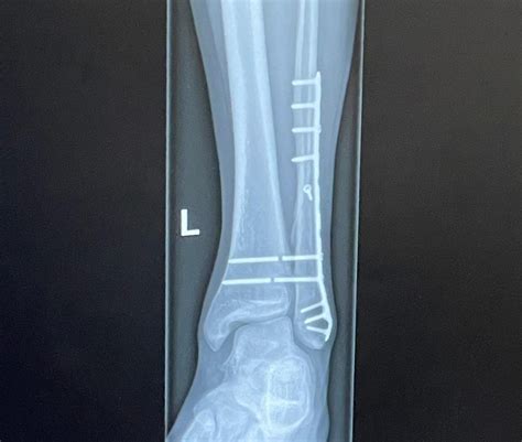 Physiologic - Recovery from an Ankle Fracture