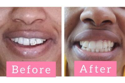 how much to remove a tooth