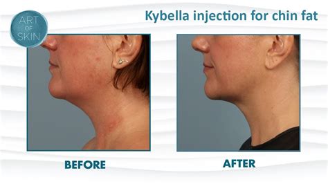 Kybella Injection For Double Chin Fat San Diego Youtube