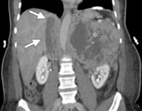 Figure From Tumors Invading The Inferior Vena Cava With Intracardiac