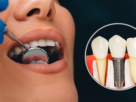 Debunking Common Misconceptions About Dental Implants Konstantine