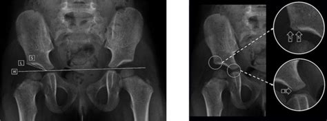 Reliability Of The Sourcil Method Of Acetabular Index Measurement In