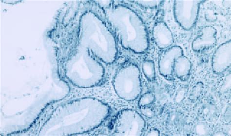 Hyperplastic polyp showing polypoid architecture, foveolar hyperplasia ...