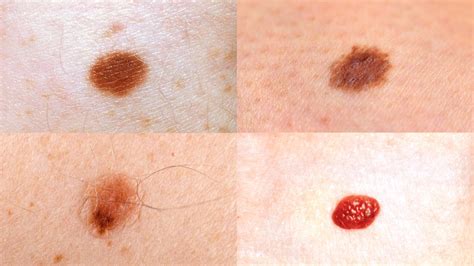 Early Stages Melanoma Skin Cancer Moles