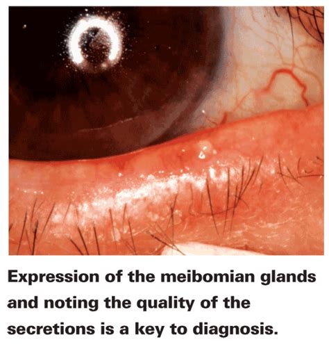 Meibomian Gland Expression