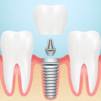 Corona Sobre Implante Dental Qu Son Tipos Precios Y Colocaci N