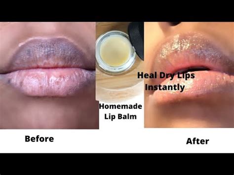 Homemade Lip Balm For Chapped Dry Lips How To Get Rid Of Very Dry Lips