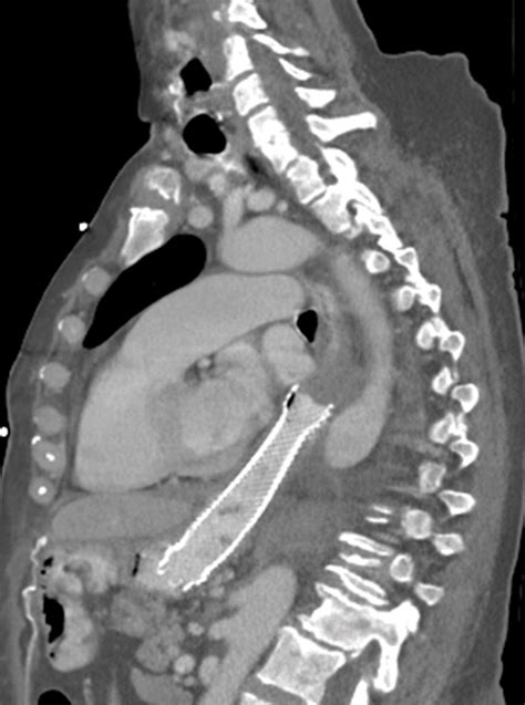 Ct Esophagography For Evaluation Of Esophageal Perforation Radiographics