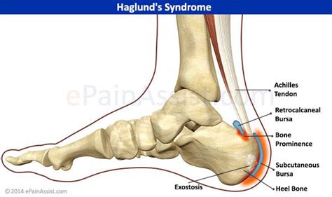 Retrocalcaneal Bursitis Bursae Located Between Posterior Calcaneus And Achilles Tendon