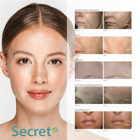 Secret Rf Sydney The Ultimate Microneedling Treatment