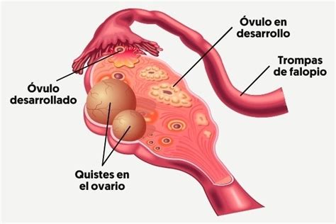 Conoce Las Causas Y Tratamiento Del Dolor De Ovarios Y Exceso De Flujo