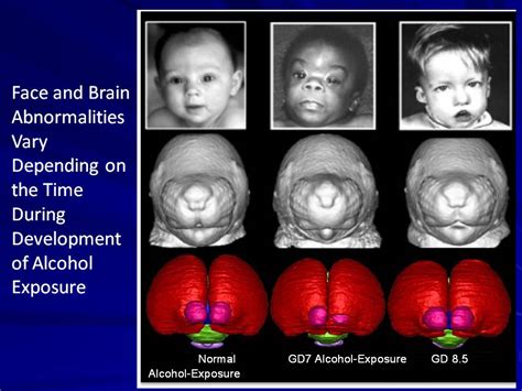 Fetal Alcohol Syndrome Brain Mri