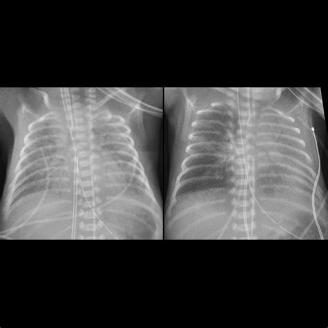 Respiratory Distress Syndrome Pediatric Radiology Reference Article Pediatric Imaging