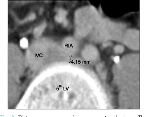 Figure 2 From Extrinsic Compression Of Left Iliac Vein Does Not Predict