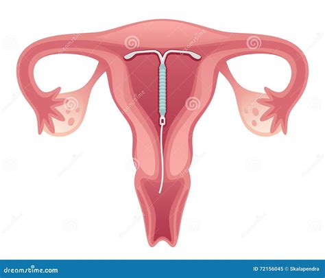 Intrauterine Device Stock Vector Illustration Of Organs 72156045