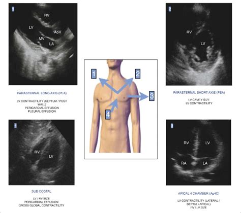 Standard Focused Transthoracic Echo Windows Blue Arrows Show The