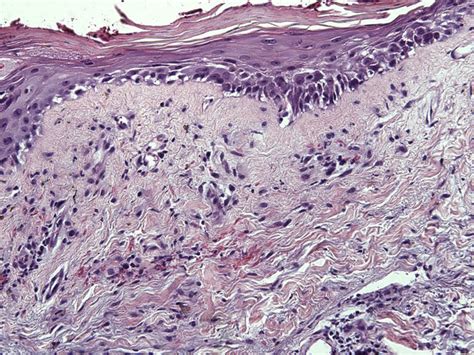 Dermatomyositis Histopathology Punch Biopsy Of Poikilodermatous