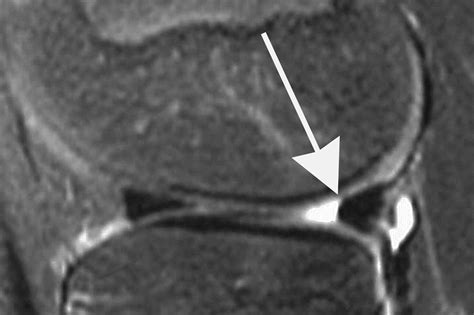 Radial Meniscal Tears Significance Incidence And Mr Appearance Ajr