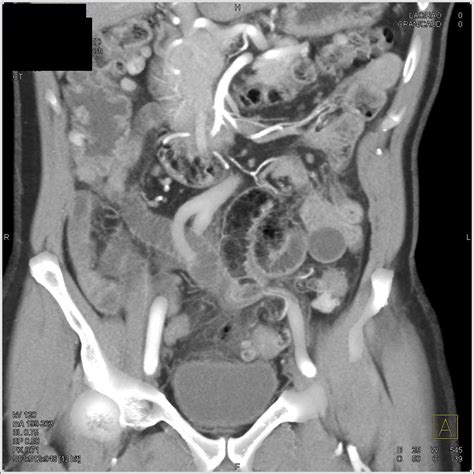 Focal Sigmoid Diverticulitis With Perforation Colon Case Studies