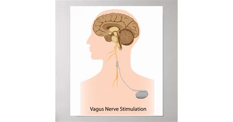 Vagus nerve stimulation therapy Poster | Zazzle