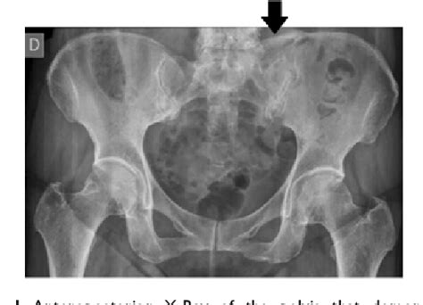 Pdf Iliolumbar Ligament Ossification What Research With This Finding