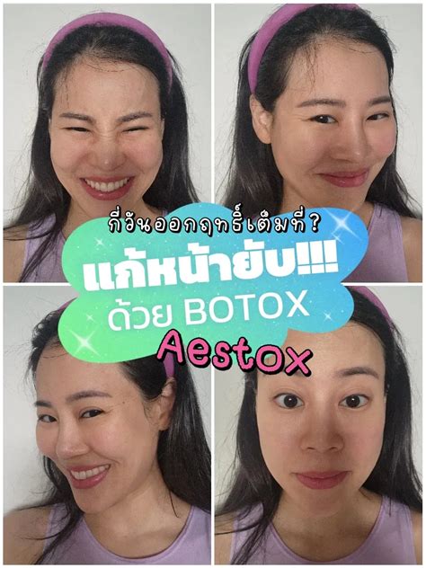 แก้หน้ายับ ด้วย Botox รีวิวโบท็อก Aestox ค่า แกลเลอรีที่โพสต์โดย