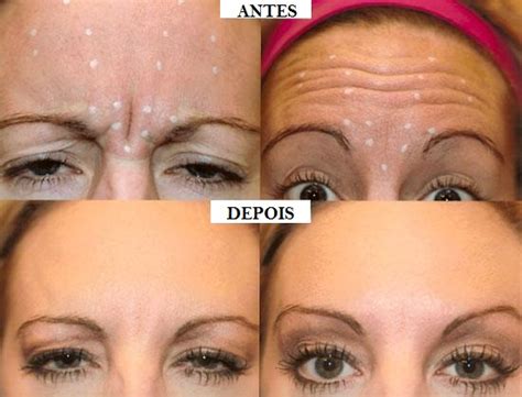 Botox Botox Antes E Depois