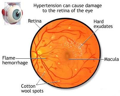 Hypertensive Retinopathy – Phoenix Eye Doctors