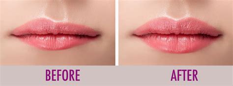 Lip Fillers In Chicago Lip Augmentation Comsetic Medicine In Chicago