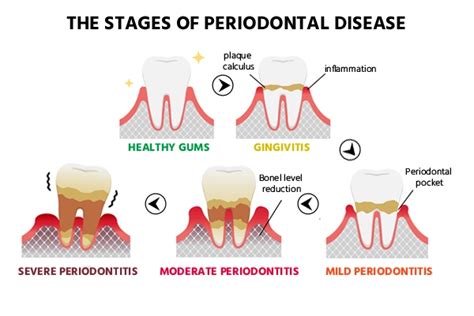 Understanding Gum Disease Causes Symptoms And Treatment Oralgos