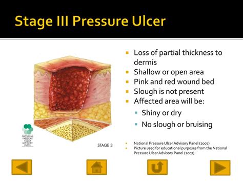 Pressure Ulcer Diagram