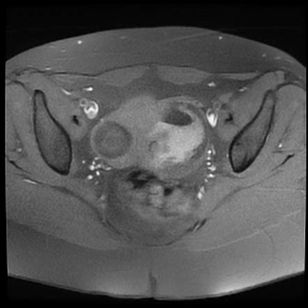 Bilateral Ovarian Dermoid Cysts Image Radiopaedia Org