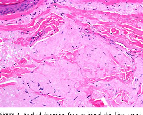 Figure From Subcutaneous Scalp Nodule As The Presenting Symptom Of