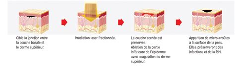 Lavieen Laser Fractionn Non Ablatif Pour Le Resurfacing Et La