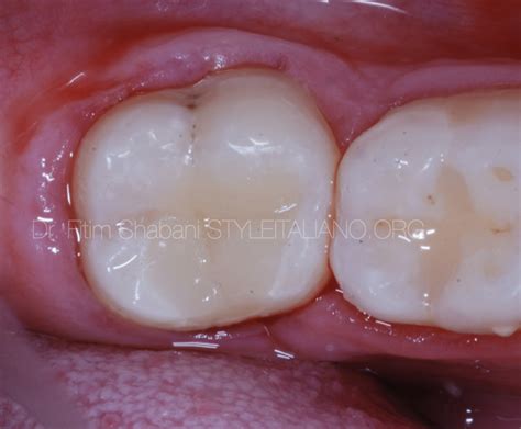 Pulpotomy In Mature Permanent Teeth Part Ii Style Italiano Endodontics