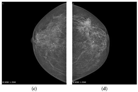 Applied Sciences Free Full Text TTCNN A Breast Cancer Detection