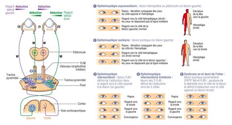 Paralysies Des Mouvements Oculaires Conjugu S Lat Raux L Sion Des