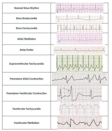 Cardiac rhythms | Medical school essentials, Nursing school essential, Medical school inspiration