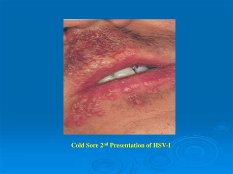 Ppt Viruses Causing Vesicular Rash Powerpoint Presentation Free