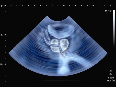 Transrectal ultrasound: Preparation, procedure, cost, and more