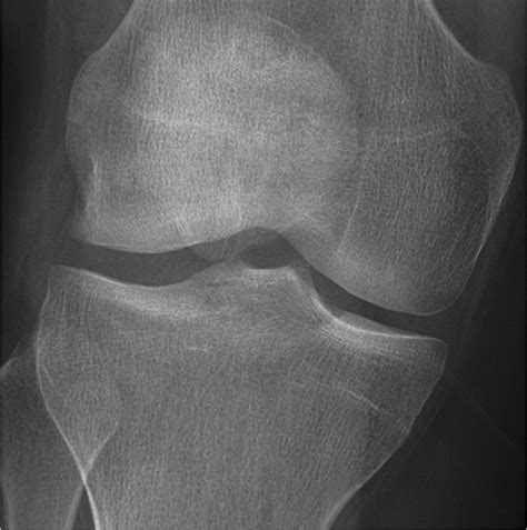 Schatzker Classification Of Tibial Plateau Fractures Use Of Ct And Mr