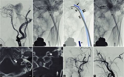 Endovascular treatment of dural arteriovenous fistula (a-d) and ...