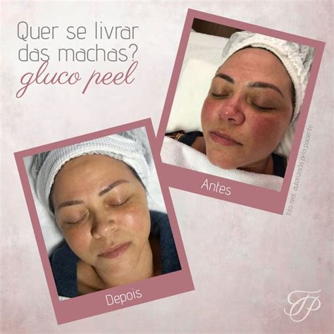 Resultado Maravilhoso Do Tratamento Gluco Peel Em Minha Paciente