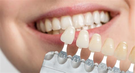 Porcelain Dental Veneers - Dentist on Harbourfront