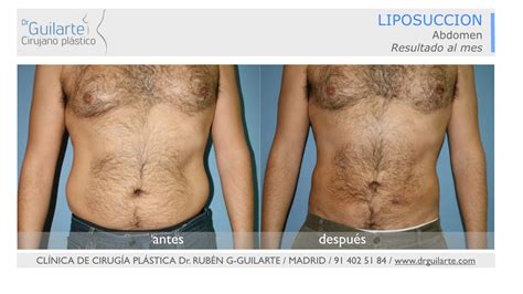 Fotos Antes Y Despu S Liposucci N Lipoescultura Opiniones Mujeres