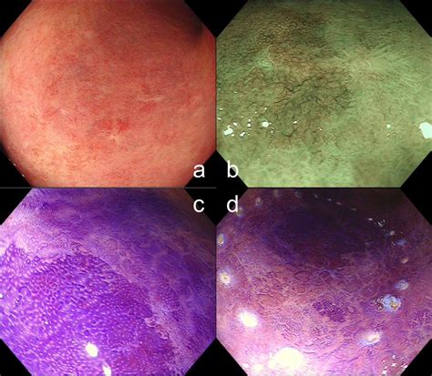 Management Of Endoscopic Submucosal Dissection For Ulcerative Colitis‐associated Neoplasia Tips