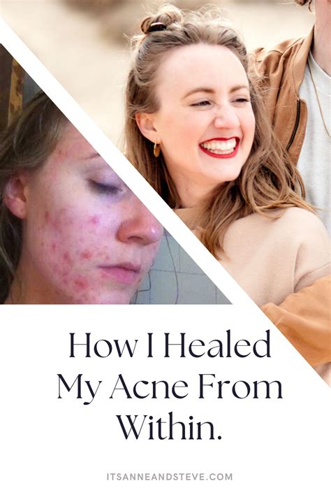 How I Cleared My Adult Cystic Acne Naturally By Trusting My Body