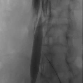 Intraoperative Fluoroscopic Image Centered On The Left Iliac Veins