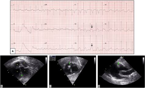 Our Patient S First Electrocardiogram Observe The Dome Shaped